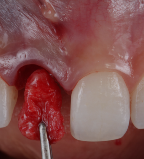 Formation immediate-dentoalveolar-restoration