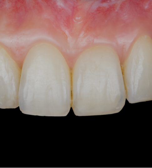 Formation  les-augmentations-osseuses-3d