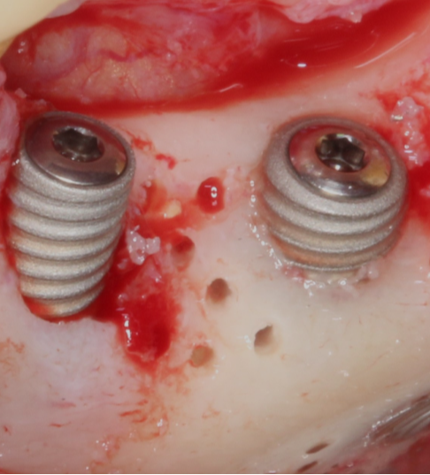 Formation  les-implants-en-secteur-esthetique