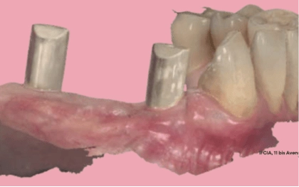 module pas-dimplanto-sans-prothese gallery image 1