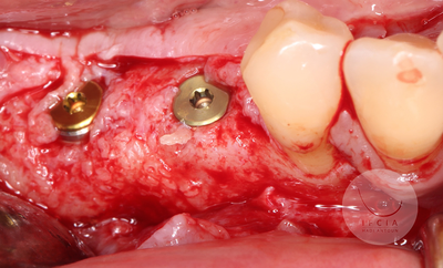 photo ifcia-hadi-antoun-expert-master-class-les-augmentation-osseuse-3D-1B.webp