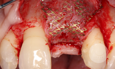 photo ifcia-hadi-antoun-expert-master-class-les-augmentation-osseuse-3D-2A.webp