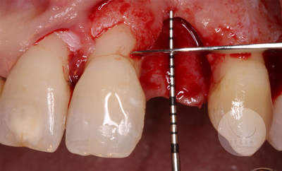 photo ifcia-hadi-antoun-expert-master-class-les-augmentation-osseuse-3D-3A.webp