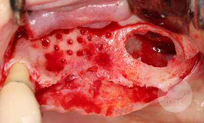 photo ifcia-hadi-antoun-expert-master-class-les-augmentation-osseuse-3D-3B.webp