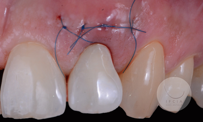 photo ifcia-hadi-antoun-les-implants-en-secteur-esthetique-1A.webp
