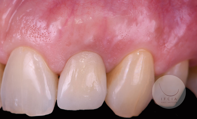 photo ifcia-hadi-antoun-les-implants-en-secteur-esthetique-1B.webp