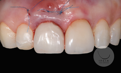 photo ifcia-hadi-antoun-les-implants-en-secteur-esthetique-2A.webp