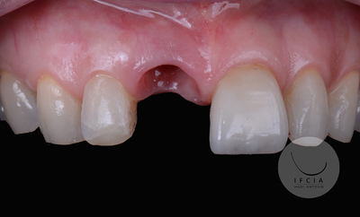 photo ifcia-hadi-antoun-les-implants-en-secteur-esthetique-2B.webp