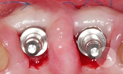 photo ifcia-hadi-antoun-les-implants-en-secteur-esthetique-3.webp