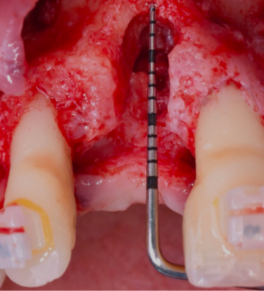 Formation  les-augmentations-osseuses-3d