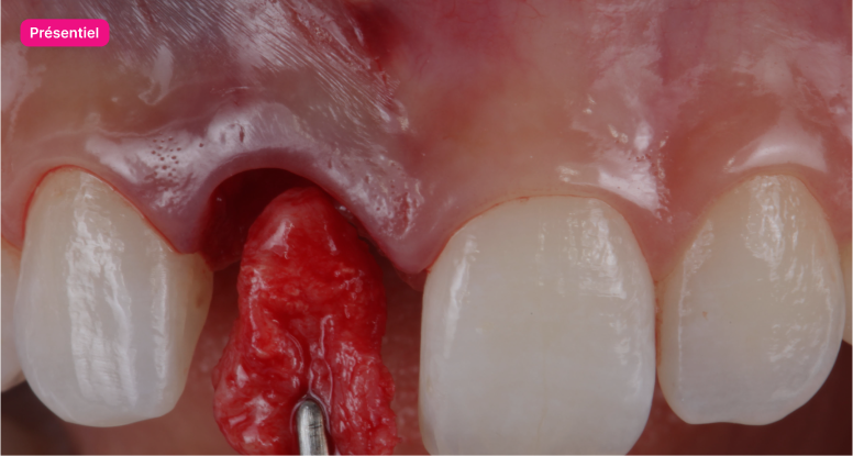 Formation  immediate-dentoalveolar-restoration