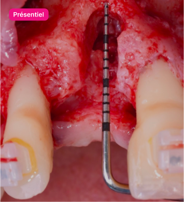 Formation  la-regeneration-osseuse-guidee